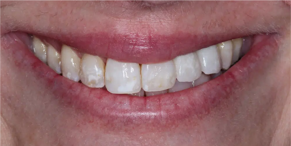 Smile Gallery in Dunwoody Dr. Amar Mistry DDS Mount Vernon Dental Group