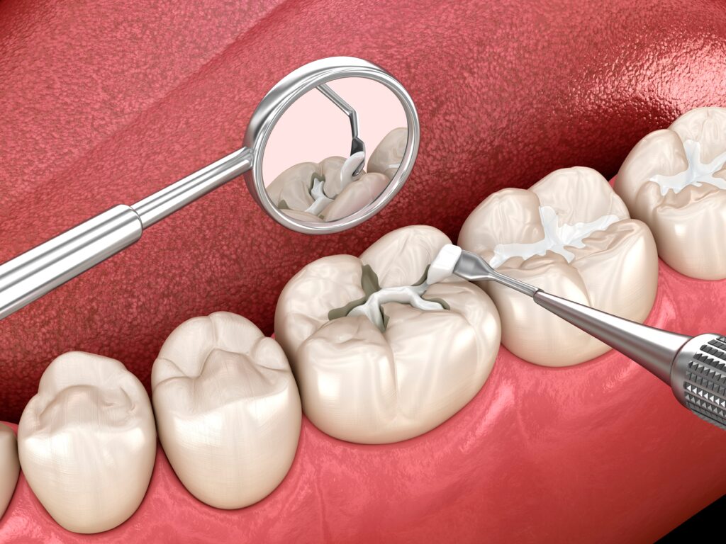 Dental Sealants Dunwoody